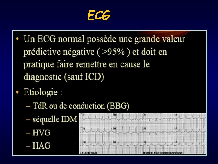 ECG 