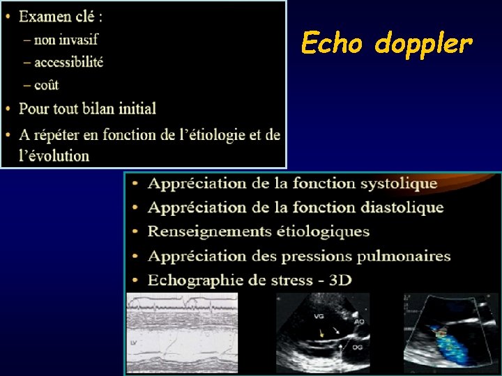 Echo doppler 