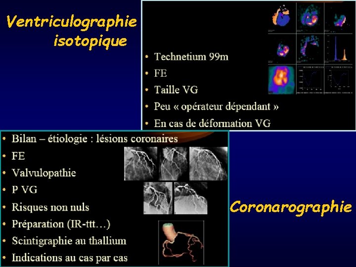 Ventriculographie isotopique Coronarographie 