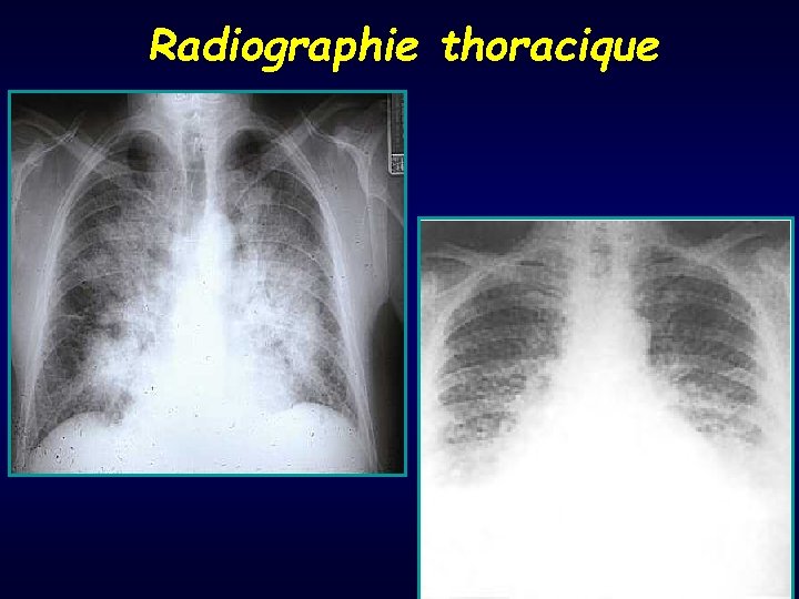 Radiographie thoracique 