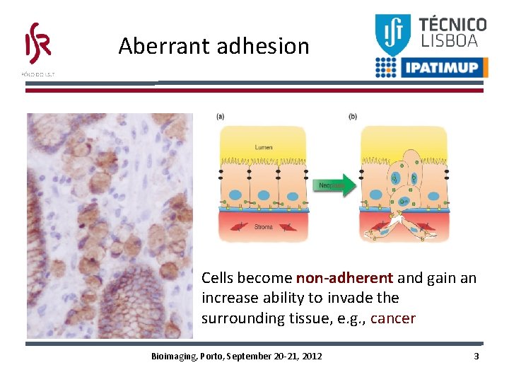 Aberrant adhesion • Cells become non-adherent and gain an increase ability to invade the Aberrant adhesion • Cells become non-adherent and gain an increase ability to invade the