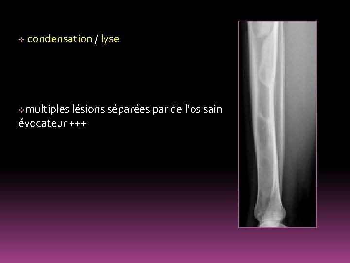 v condensation / lyse multiples lésions séparées par de l’os sain évocateur +++ v