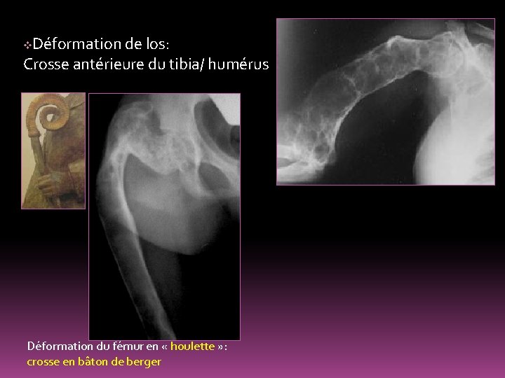 Déformation de los: Crosse antérieure du tibia/ humérus v Déformation du fémur en «