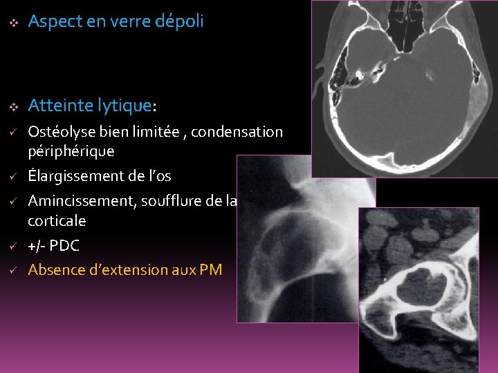 v Aspect en verre dépoli v Atteinte lytique: ü ü ü Ostéolyse bien limitée