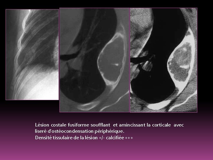 Lésion costale fusiforme soufflant et amincissant la corticale avec liseré d’ostéocondensation périphérique. Densité tissulaire