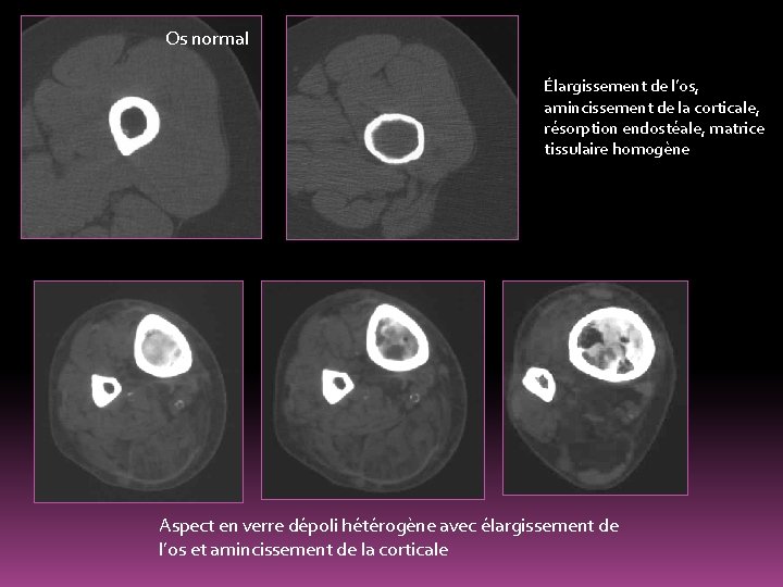 Os normal Élargissement de l’os, amincissement de la corticale, résorption endostéale, matrice tissulaire homogène