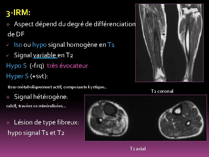 3 -IRM: Aspect dépend du degré de différenciation de DF ü Iso ou hypo