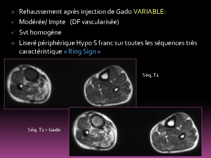 v ü ü v Rehaussement après injection de Gado VARIABLE: Modérée/ Impte (DF vascularisée)