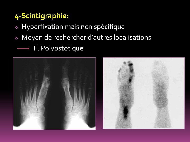 4 -Scintigraphie: Hyperfixation mais non spécifique v Moyen de recher d’autres localisations F. Polyostotique