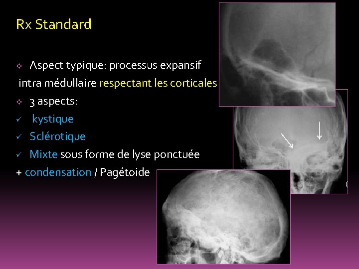Rx Standard Aspect typique: processus expansif intra médullaire respectant les corticales v 3 aspects: