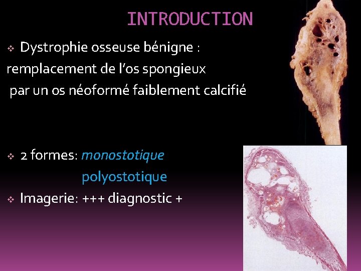 INTRODUCTION Dystrophie osseuse bénigne : remplacement de l’os spongieux par un os néoformé faiblement