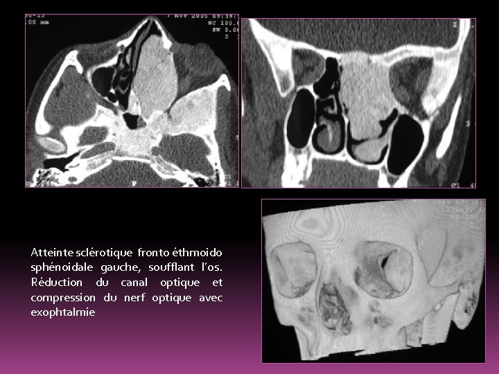 Atteinte sclérotique fronto éthmoido sphénoidale gauche, soufflant l’os. Réduction du canal optique et compression