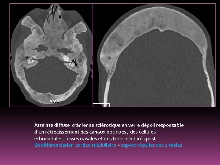 Atteinte diffuse crânienne sclérotique en verre dépoli responsable d’un rétrécissement des canaux optiques ,