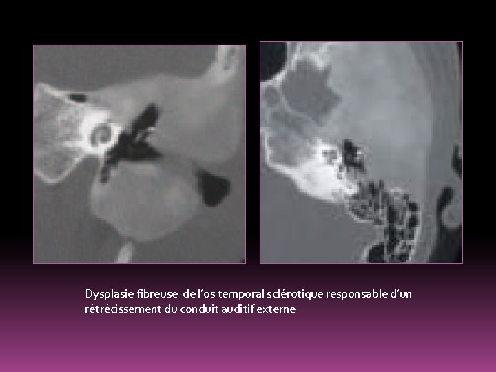 Dysplasie fibreuse de l’os temporal sclérotique responsable d’un rétrécissement du conduit auditif externe 