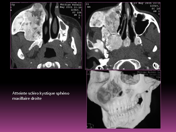 Atteinte scléro kystique sphéno maxillaire droite 