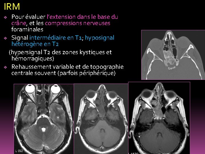 IRM Pour évaluer l’extension dans le base du crâne, et les compressions nerveuses foraminales