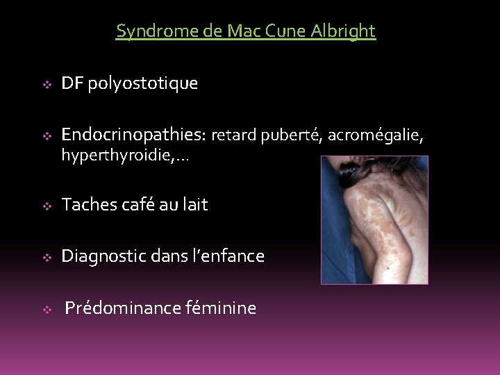 Syndrome de Mac Cune Albright v DF polyostotique v Endocrinopathies: retard puberté, acromégalie, hyperthyroidie,