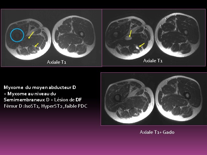 Axiale T 1 Myxome du moyen abducteur D + Myxome au niveau du Semimembraneux