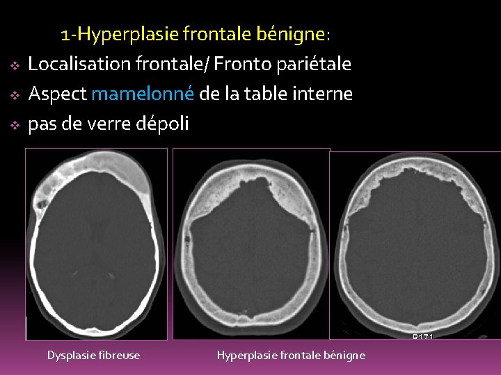 v v v 1 -Hyperplasie frontale bénigne: Localisation frontale/ Fronto pariétale Aspect mamelonné de