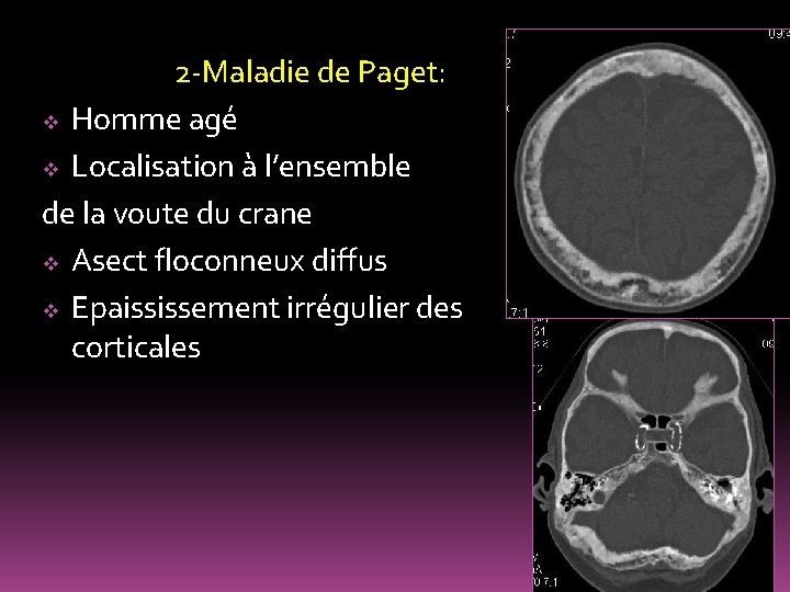 2 -Maladie de Paget: v Homme agé v Localisation à l’ensemble de la voute