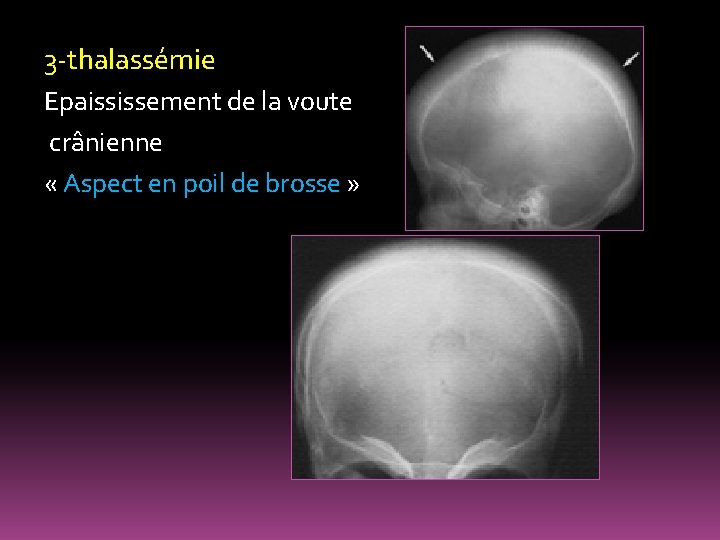 3 -thalassémie Epaississement de la voute crânienne « Aspect en poil de brosse »