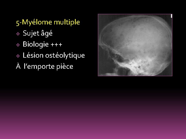 5 -Myélome multiple v Sujet âgé v Biologie +++ v Lésion ostéolytique À l’emporte