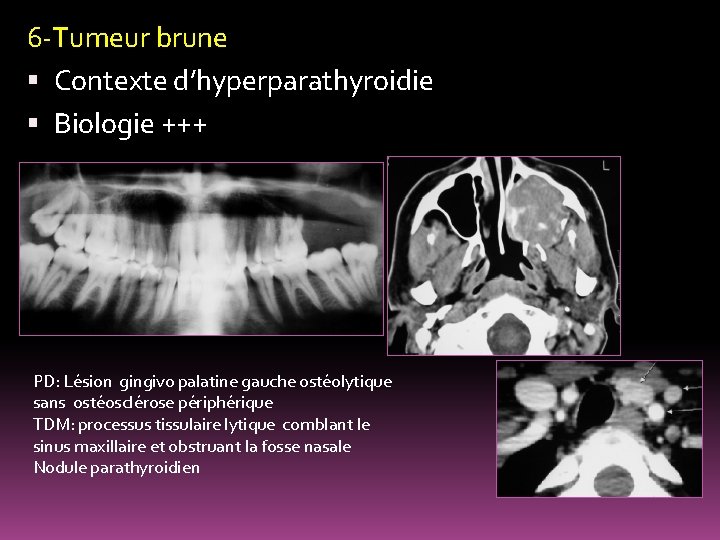 6 -Tumeur brune Contexte d’hyperparathyroidie Biologie +++ PD: Lésion gingivo palatine gauche ostéolytique sans