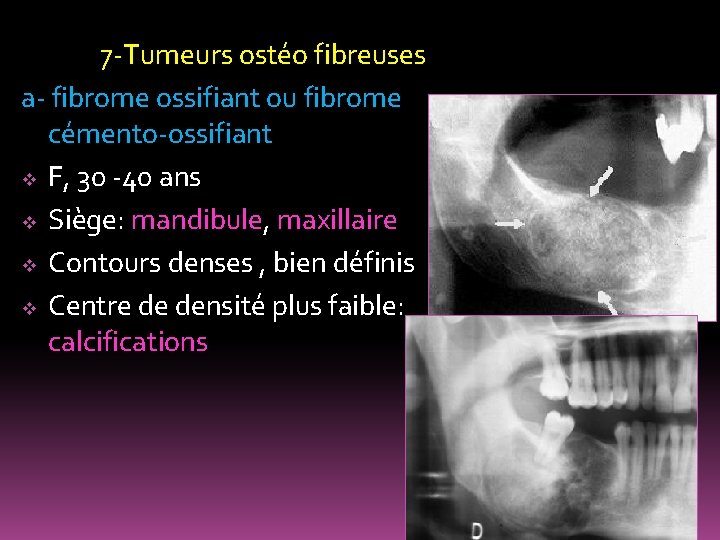 7 -Tumeurs ostéo fibreuses a- fibrome ossifiant ou fibrome cémento-ossifiant v F, 30 -40