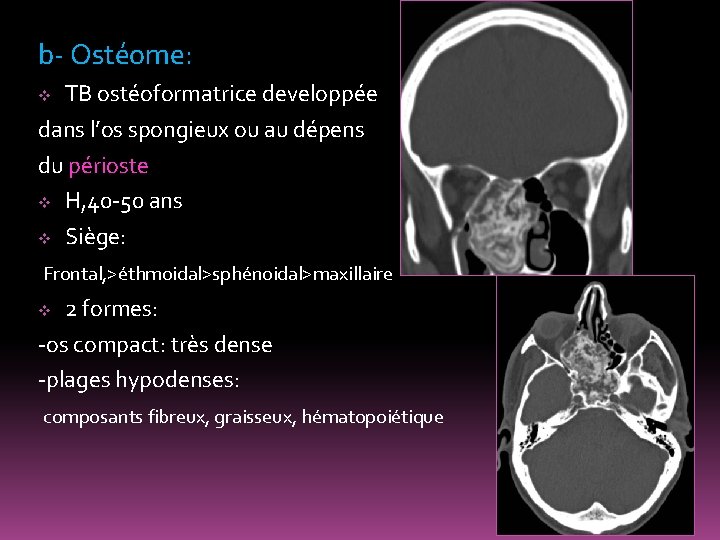 b- Ostéome: TB ostéoformatrice developpée dans l’os spongieux ou au dépens du périoste v