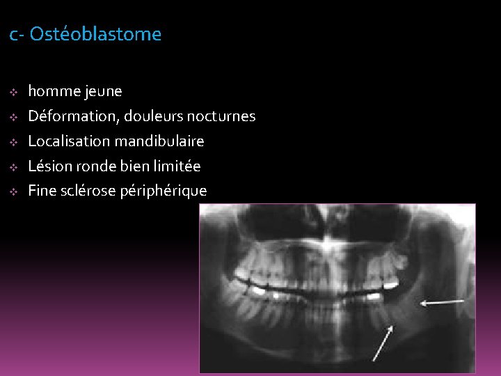 c- Ostéoblastome v v v homme jeune Déformation, douleurs nocturnes Localisation mandibulaire Lésion ronde