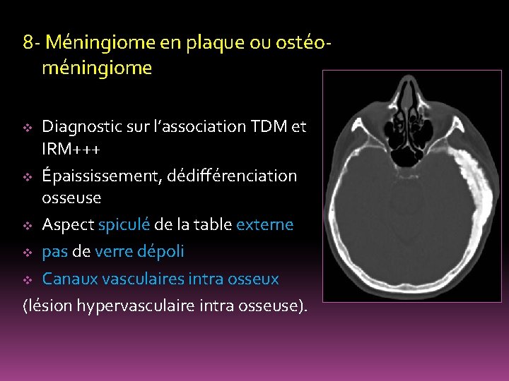 8 - Méningiome en plaque ou ostéoméningiome Diagnostic sur l’association TDM et IRM+++ v