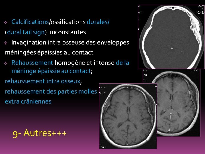 Calcifications/ossifications durales/ (dural tail sign): inconstantes v Invagination intra osseuse des enveloppes méningées épaissies