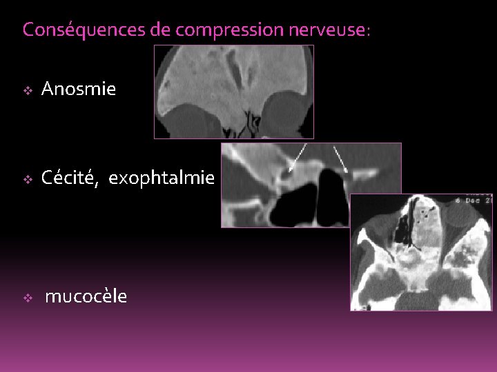 Conséquences de compression nerveuse: v Anosmie v Cécité, exophtalmie v mucocèle 