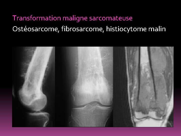 Transformation maligne sarcomateuse Ostéosarcome, fibrosarcome, histiocytome malin 