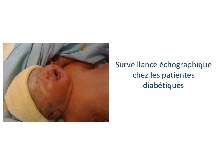 Surveillance échographique chez les patientes diabétiques 