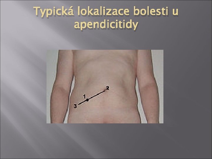 Typická lokalizace bolesti u apendicitidy 