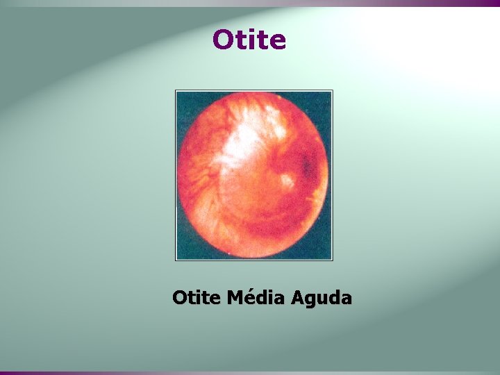 Otite Média Aguda 