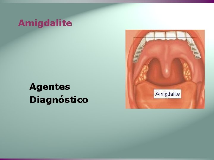 Amigdalite Agentes Diagnóstico 