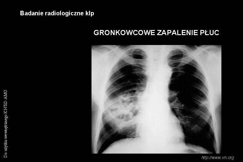 Badanie radiologiczne klp Do użytku wewnętrznego KNTi. D AMG GRONKOWCOWE ZAPALENIE PŁUC http: //www.