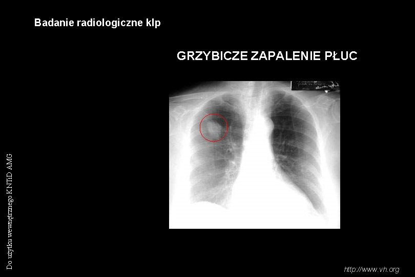 Badanie radiologiczne klp Do użytku wewnętrznego KNTi. D AMG GRZYBICZE ZAPALENIE PŁUC http: //www.