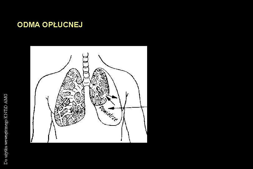 Do użytku wewnętrznego KNTi. D AMG ODMA OPŁUCNEJ 