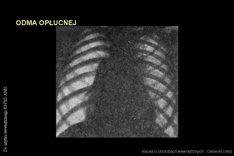Do użytku wewnętrznego KNTi. D AMG ODMA OPŁUCNEJ Nauka o chorobach wewnętrznych Orłowski (red)
