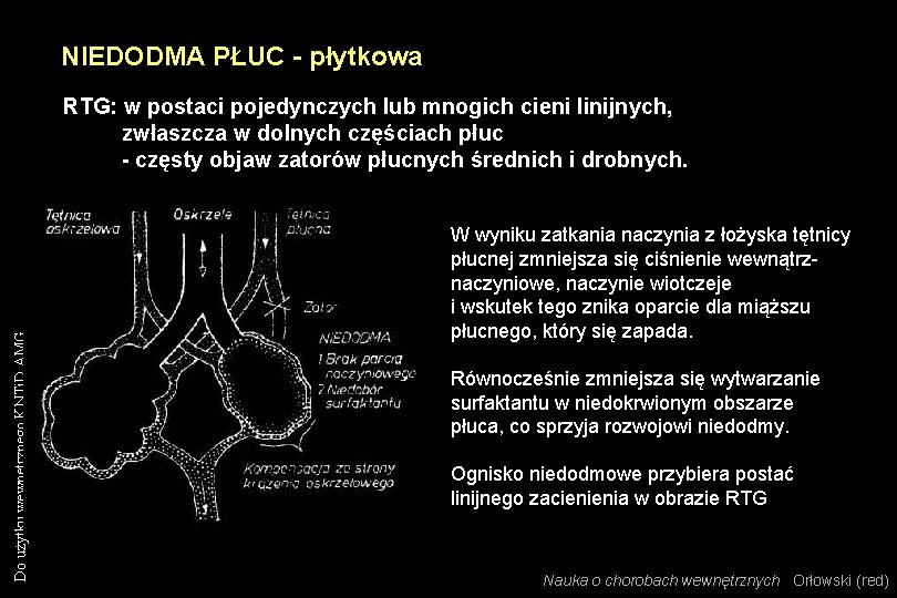 NIEDODMA PŁUC - płytkowa Do użytku wewnętrznego KNTi. D AMG RTG: w postaci pojedynczych