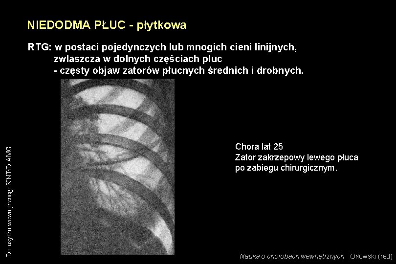 NIEDODMA PŁUC - płytkowa Do użytku wewnętrznego KNTi. D AMG RTG: w postaci pojedynczych NIEDODMA PŁUC - płytkowa Do użytku wewnętrznego KNTi. D AMG RTG: w postaci pojedynczych
