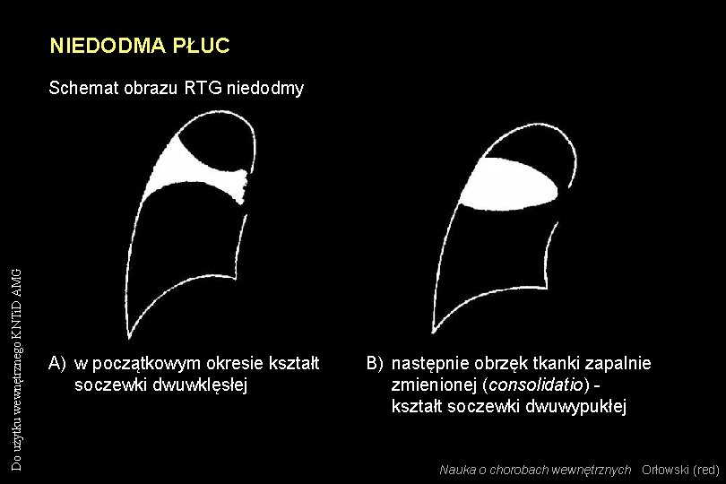 NIEDODMA PŁUC Do użytku wewnętrznego KNTi. D AMG Schemat obrazu RTG niedodmy A) w