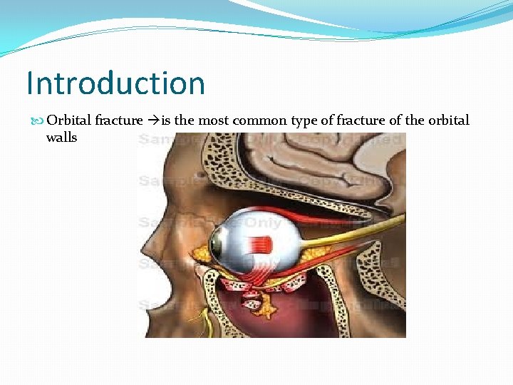 Introduction Orbital fracture is the most common type of fracture of the orbital walls