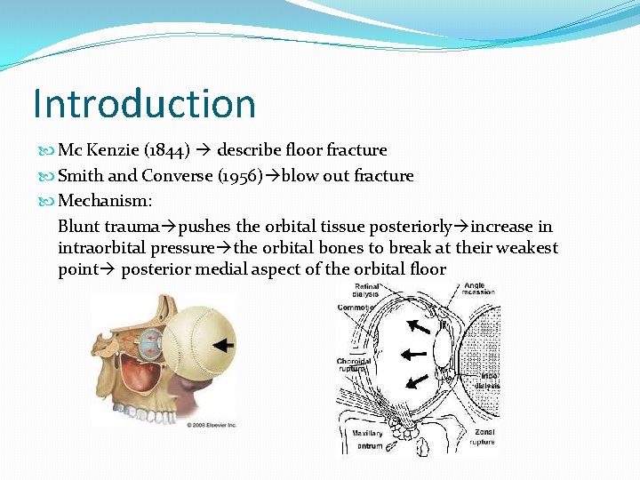 Introduction Mc Kenzie (1844) describe floor fracture Smith and Converse (1956) blow out fracture