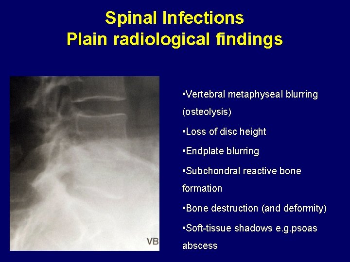Spinal Infections Plain radiological findings • Vertebral metaphyseal blurring (osteolysis) • Loss of disc