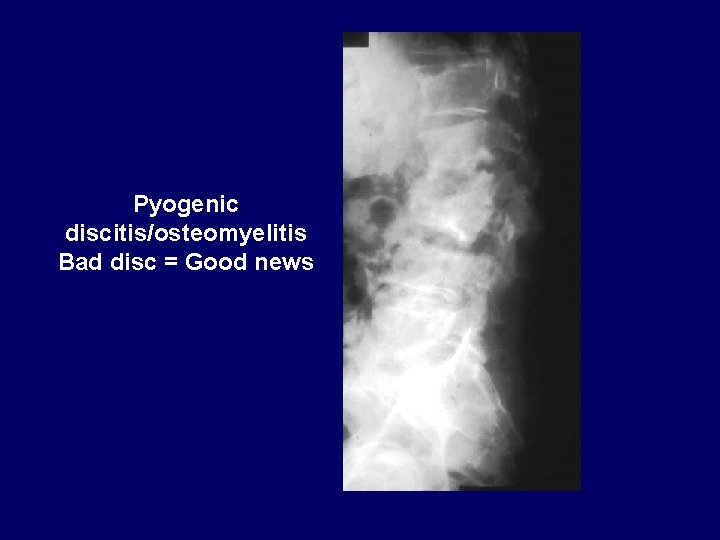 Pyogenic discitis/osteomyelitis Bad disc = Good news 