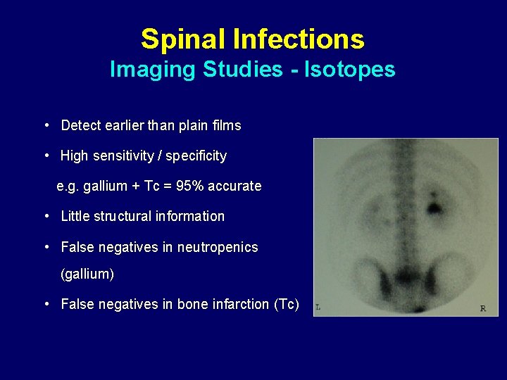 Spinal Infections Imaging Studies - Isotopes • Detect earlier than plain films • High